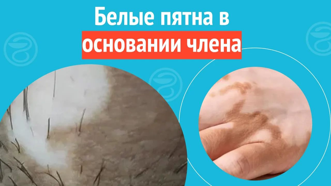 😶_🌫️ Белые пятна в основании члена. Клинический случай №1258