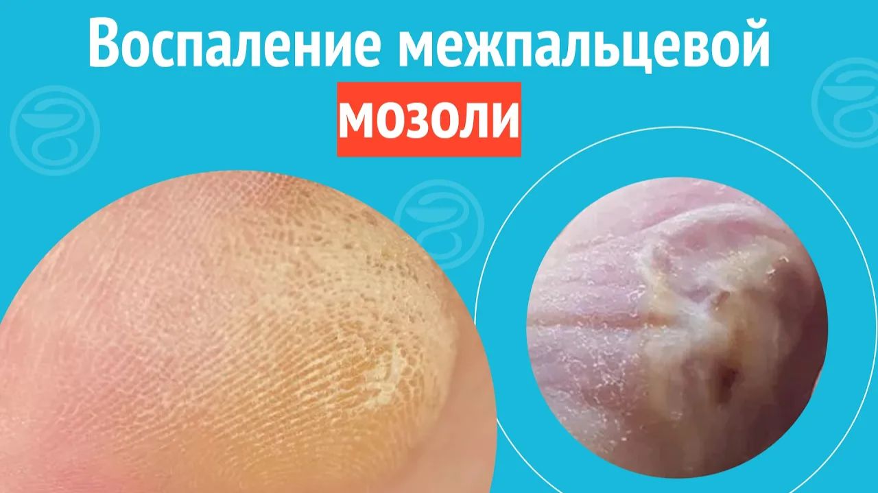 🦶 Воспаление межпальцевой мозоли. Клинический случай №1250