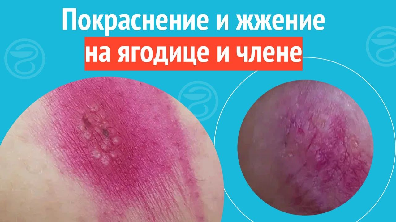 🦵 Покраснение и жжение на ягодице и члене. Клинический случай №1262