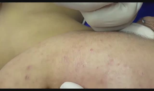 Глубокое удаление акне и прыщей с лица