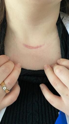 ЕСЛИ УДАЛЕНА ЩИТОВИДНАЯ ЖЕЛЕЗА РЕКОМЕНДАЦИИ