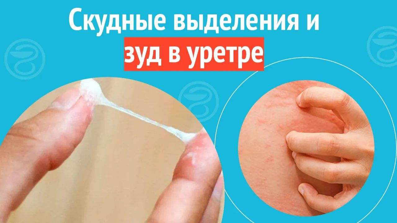 👉 Скудные выделения и зуд в уретре. Клинический случай №1255
