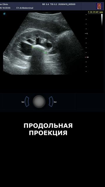 Коралловидный камень правой почки на УЗИ