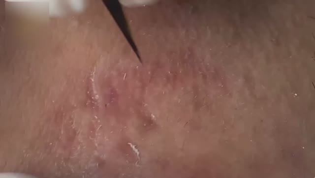 Полное удаление черных точек и акне