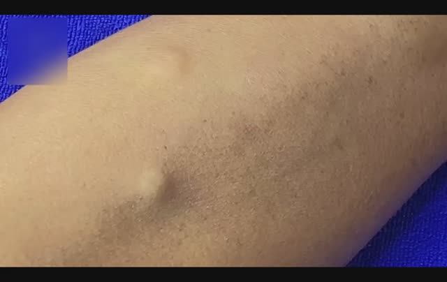 Удаление стеатоцистов на руке и акне на лице.