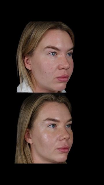 снятие гипса после ринопластики!