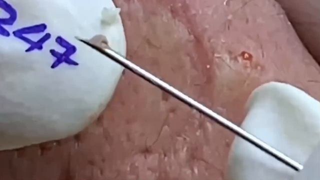 #284 Чистка лица от угрей и акне. Выдавливание прыщей. Удаление черных точек и комедонов