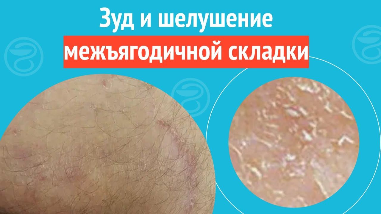 🫤 Зуд и шелушение межъягодичной складки. Клинический случай №1252