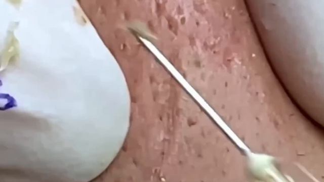 #285 Чистка лица от угрей и акне. Выдавливание прыщей. Удаление черных точек и комедонов