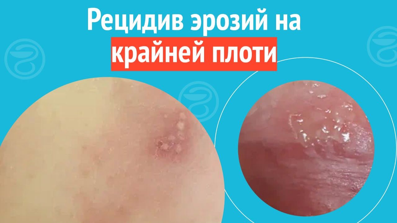 😲 Рецидив эрозий на крайней плоти. Клинический случай №1257