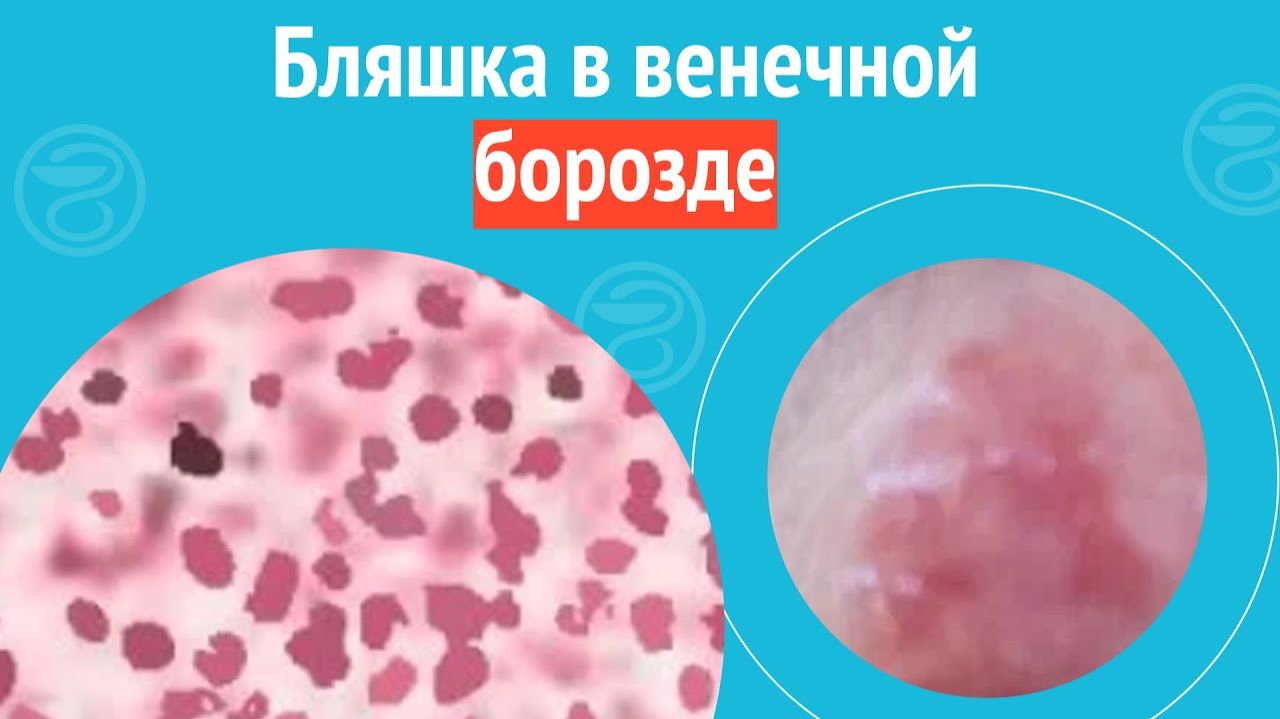 😥 Бляшка в венечной борозде. Клинический случай №1253