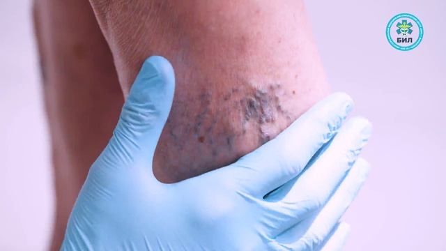 Что такое облитерирующий атеросклероз?