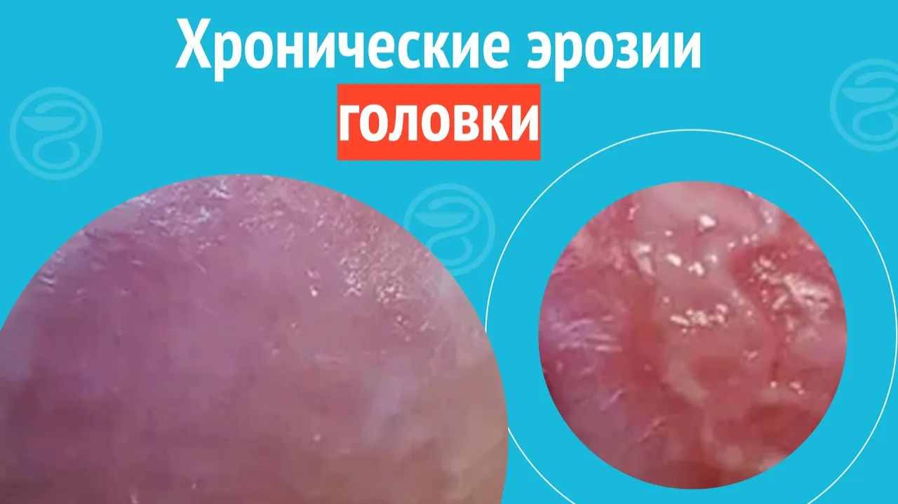 😟 Хронические эрозии головки. Клинический случай №1259