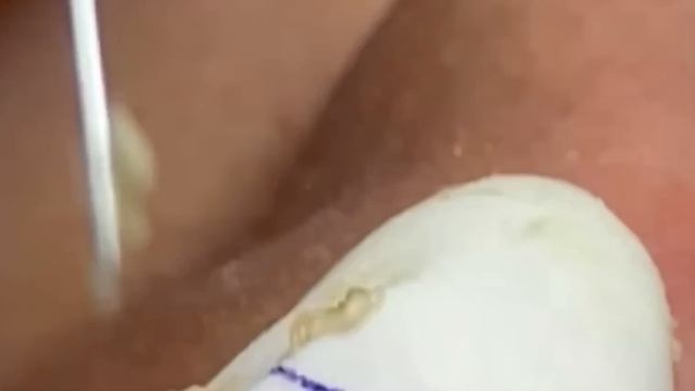 289 Чистка лица от угрей и акне. Выдавливание прыщей. Удаление черных точек и комедонов