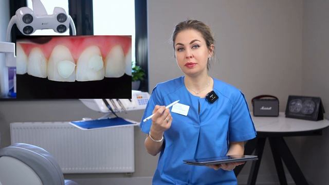 Прямые реставрации: лечение моих зубов