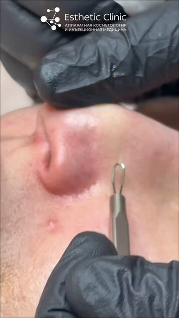 ЧИСТКА ЛИЦА ПЕРЕЗАГРУЗКА ДЛЯ ВАШЕЙ КОЖИ