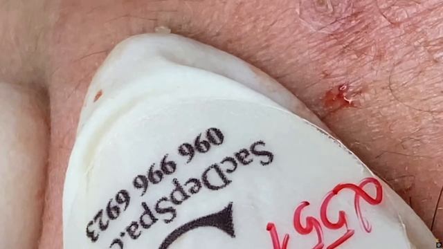 Выдавливание Тяжелого Лба и Очищение пор от Кожного Сала