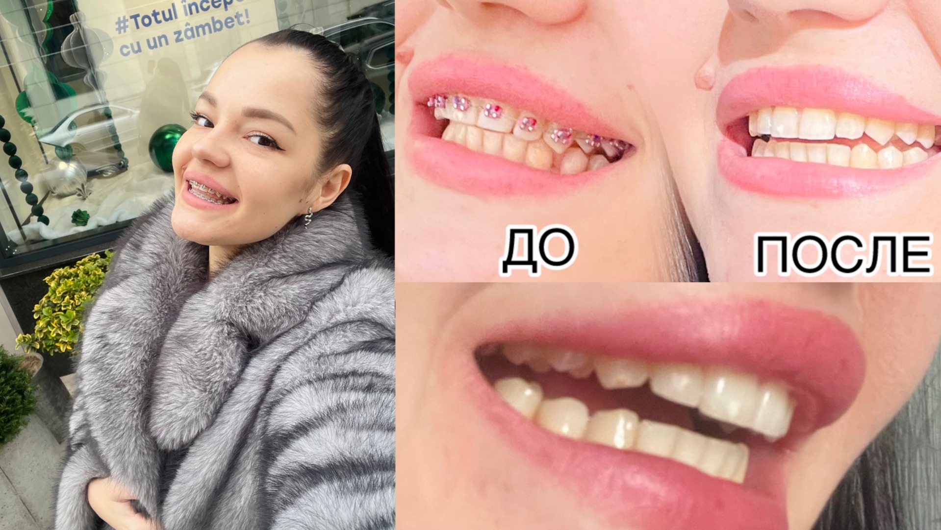 Я СНЯЛА БРЕКЕТЫ  что дальше и мои рекомендации