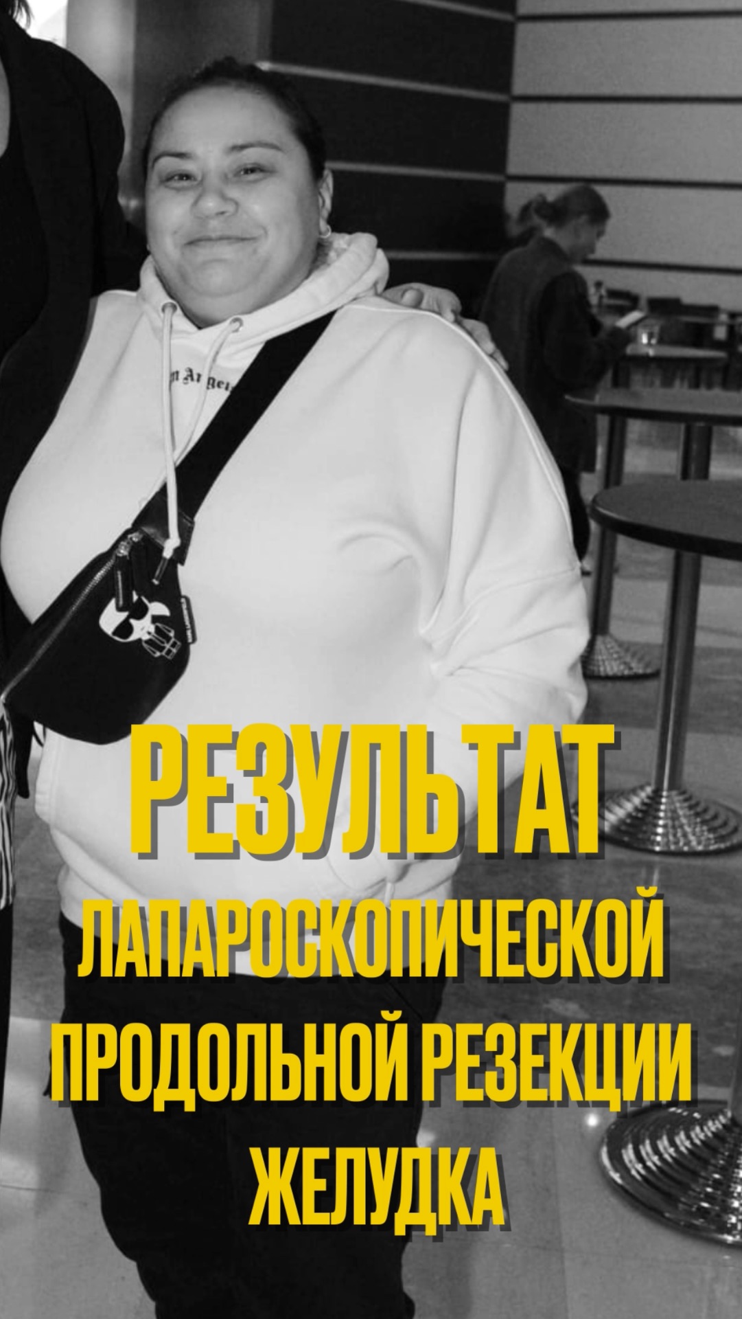 ДоПосле: Баритарическая операция изменила меня!