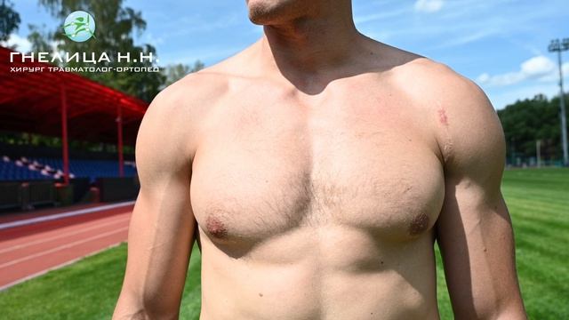 Разрыв большой грудной мышцы. Операция. Отзыв пациента.