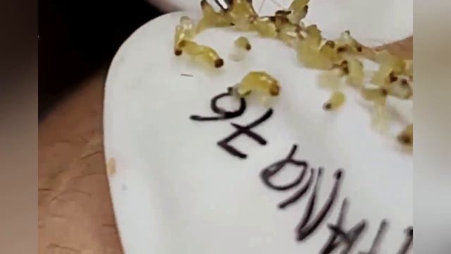 Выдавливание прыщей угрей черных точек и камедонов 389