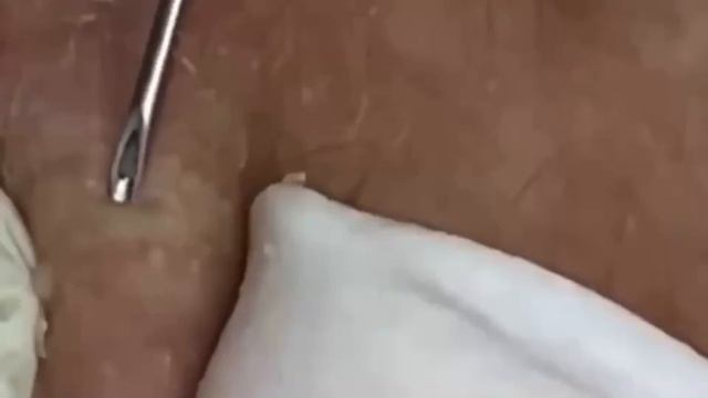 292 Чистка лица от угрей и акне. Выдавливание прыщей. Удаление черных точек и комедонов