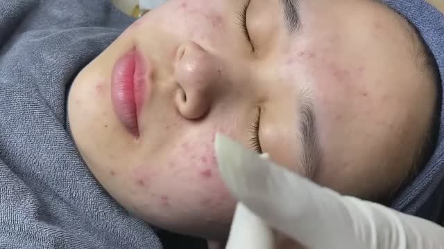 Очищение лица от акне. Множество сюрпризов под кожей.