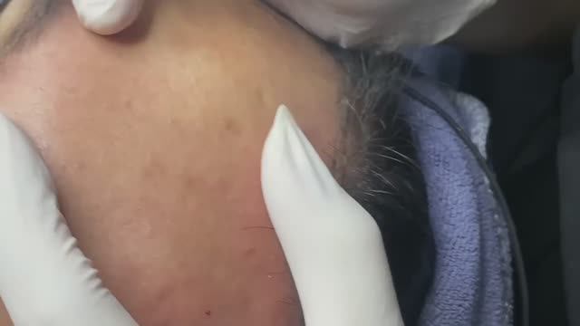 Кожа в сальных нитях и черных точках  смотрим чистку