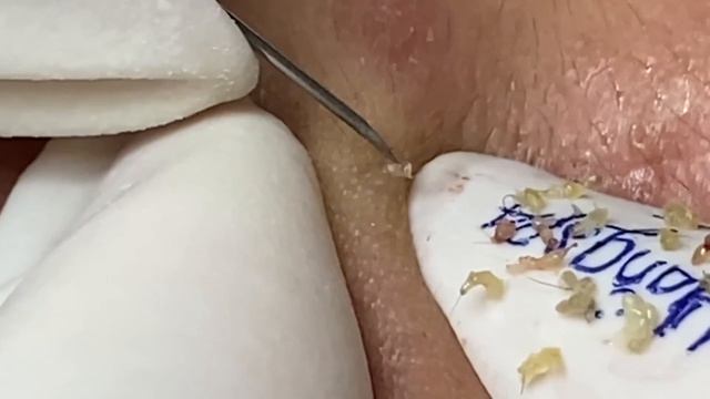 Удаление комедонов на очень проблемной коже