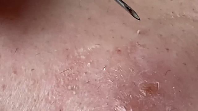 Очищение лица от акне. Множество сюрпризов под кожей.