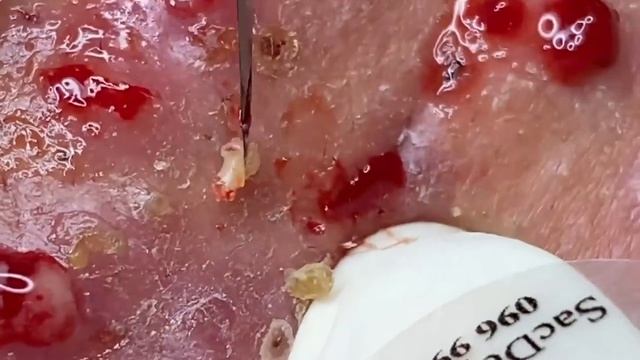 Выдавливание прыщей угрей черных точек и камедонов 390