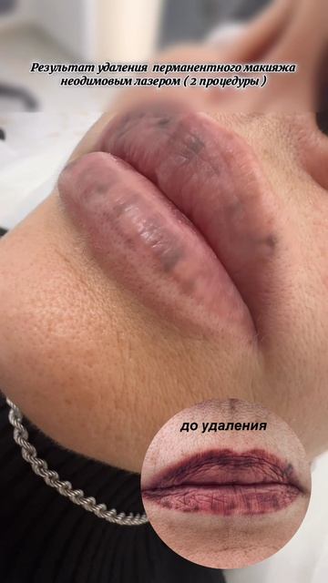 Удаление перманентного макияжа губ
