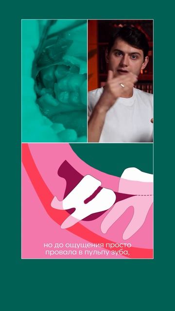 Удаление зуба на нерве