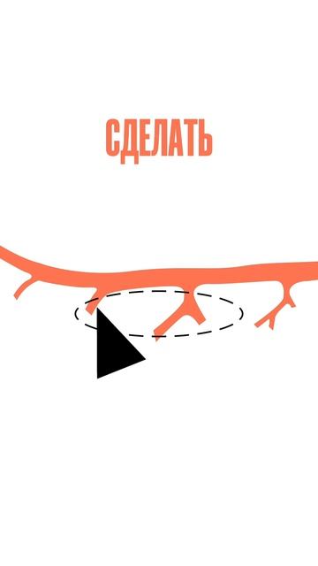 Что делать, если артерия синуса попала в область окна во время ОСЛ