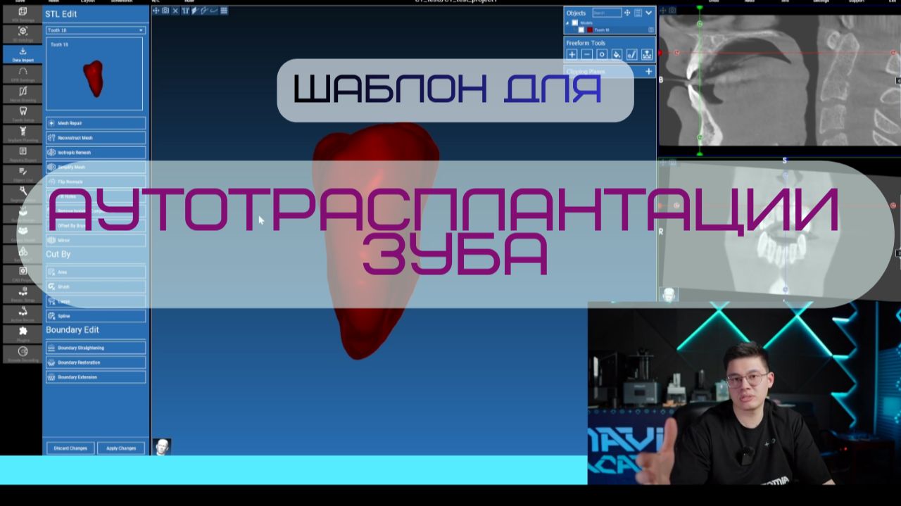 Аутотрансплантация зуба! Как сделать шаблон и клиниеческий пример✍️