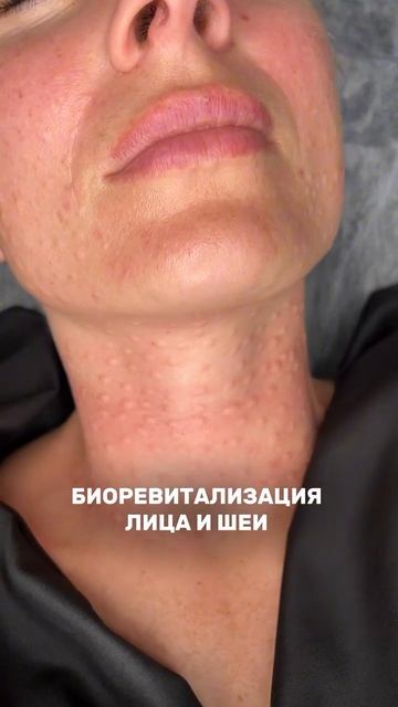 Биоревитализация лица и шеи