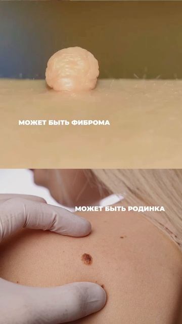 Удаление папиллом самостоятельно, можно или нельзя