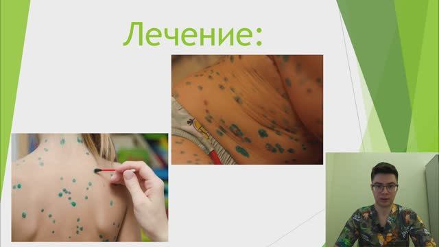 Ветряная оспа ч. 2
