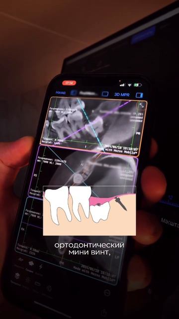 Клинический случай удаления зуба мудрости