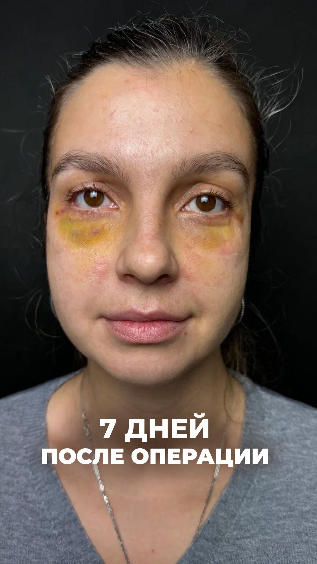 Нижняя блефаропластика.  7 сутки после операции