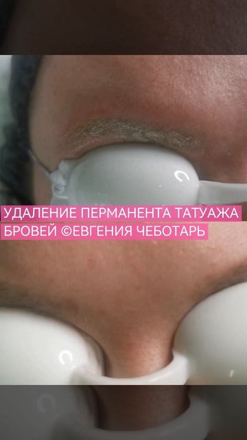 УДАЛЕНИЕ ПЕРМАНЕНТА ТАТУАЖА БРОВЕЙ | ЦЕНТР КОРРЕКЦИИ ЛИЦА, ТЕЛА И ДУШИ