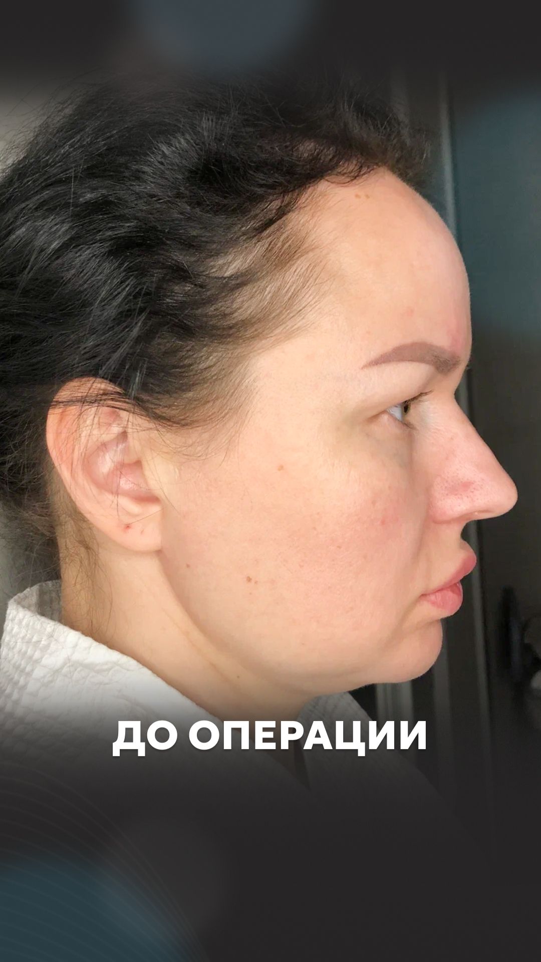 Липосакция подбородка: подготовка