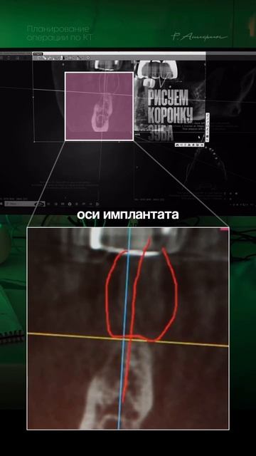 КЛКТ планирование имплантации