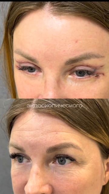 Блефаропластика, эндоскопический лифтинг Бага Д.К. Capital Med Clinic