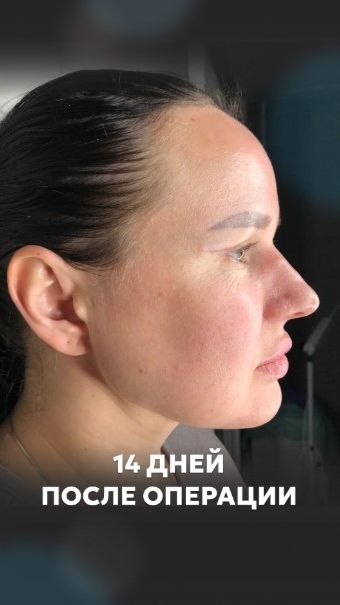 Липосакция подбородка: результат спустя 14 дней