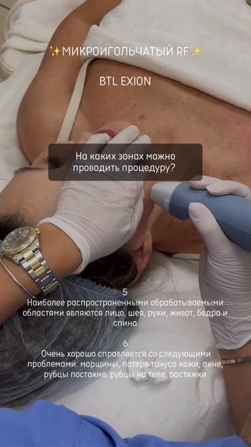 Микроигольчатый RF-лифтинг  EXION BTL