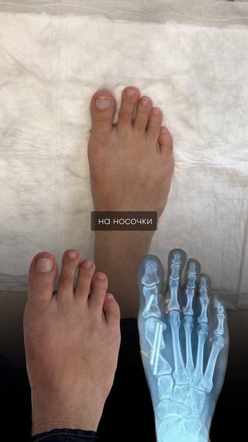 🏅До и после операции Hallux Valgus
