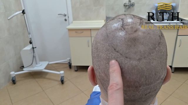 Одна донорская зона — четыре операции. Возможно ли это?