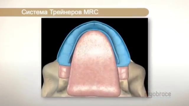 Myobrace информация для родителей и пациентов
