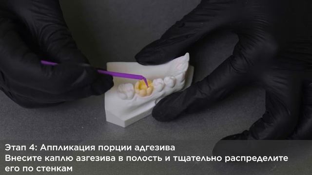 Prime&Bond Universal: адгезивный протокол в технике селективного протравливания